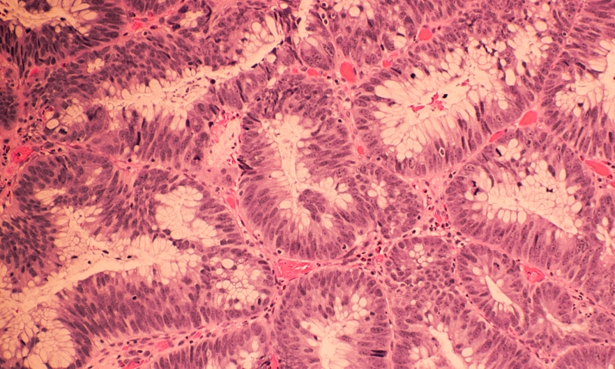 Colonic Adenocarcinoma