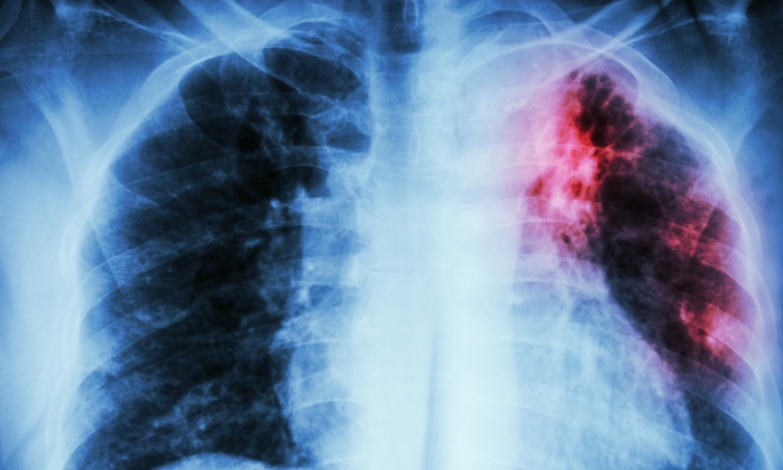 Chest X-ray : interstitial infiltration at left upper lung due to Mycobacterium Tuberculosis infection