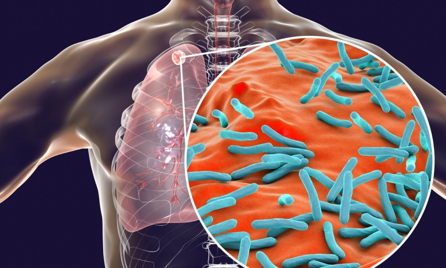 Computer rendering of human torso with mass in its lung overlaid with close-up of Mycobacterium tuberculosis bacteria.