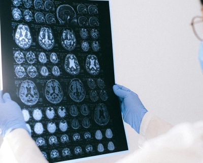 A doctor holding an MRI result of the brain