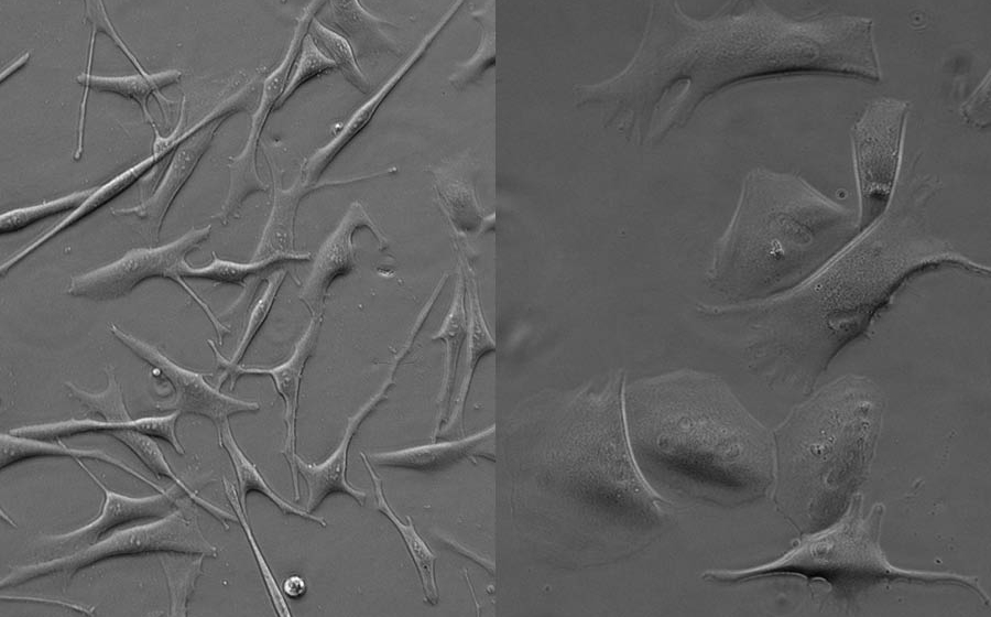 light microscopy images of acral lentiginous melanoma: left, many narrow cells with some needle-like protrusions; right the cells are flattened and spread out.
